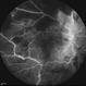 Frosted Branch Angiitis-3 Frosted Branch Angiitis-3